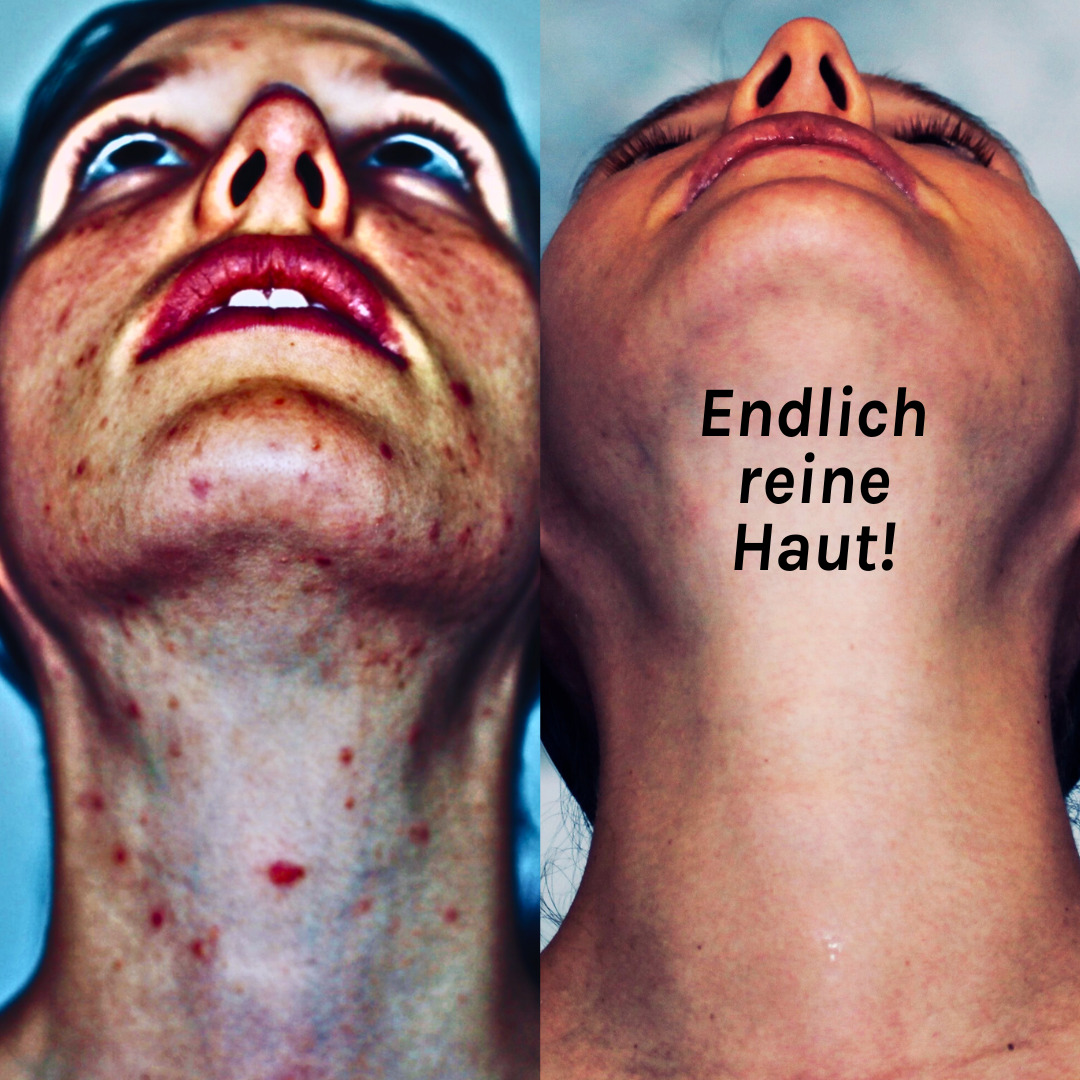 Akne-Ernährung-Coaching mit Akne-Kochbuch
