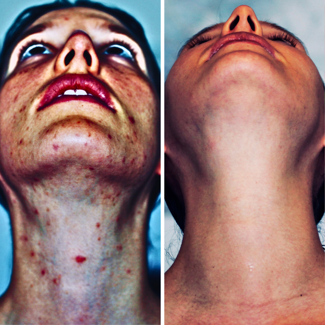 Akne-Coaching mit Akne-Kochbuch